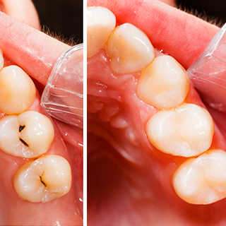 Dental-Fillings Dental-Fillings