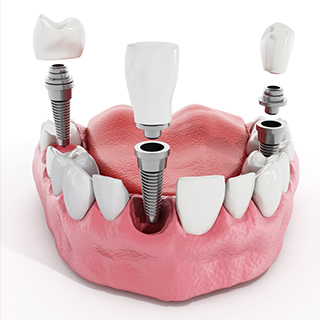 Dental-Implants