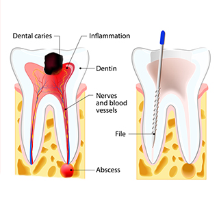 Root-Canals Root-Canals