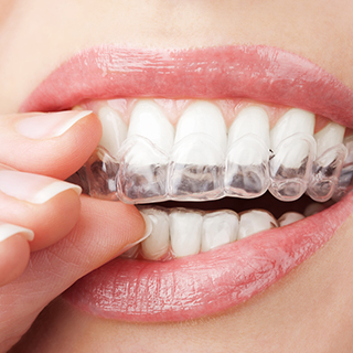 invisalign invisalign