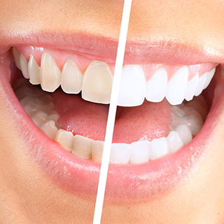 teeth-whitening