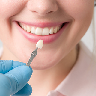 veneers veneers