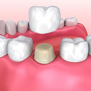 Dental-Crowns-and-Bridges